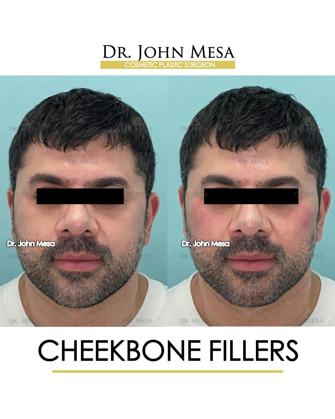 Cheekbone Filler Before & After Gallery - Patient 148735126 - Image 1