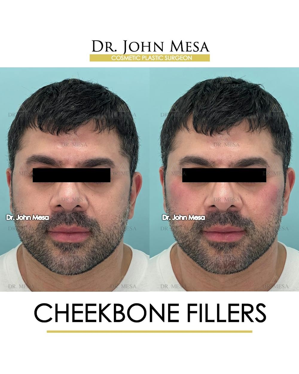 Cheekbone Filler Before & After Gallery - Patient 148735126 - Image 1