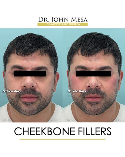 Cheekbone Filler Before & After Gallery - Patient 148735126 - Image 1