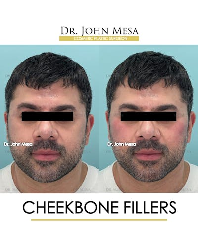 Cheekbone Filler Before & After Gallery - Patient 148735126 - Image 1