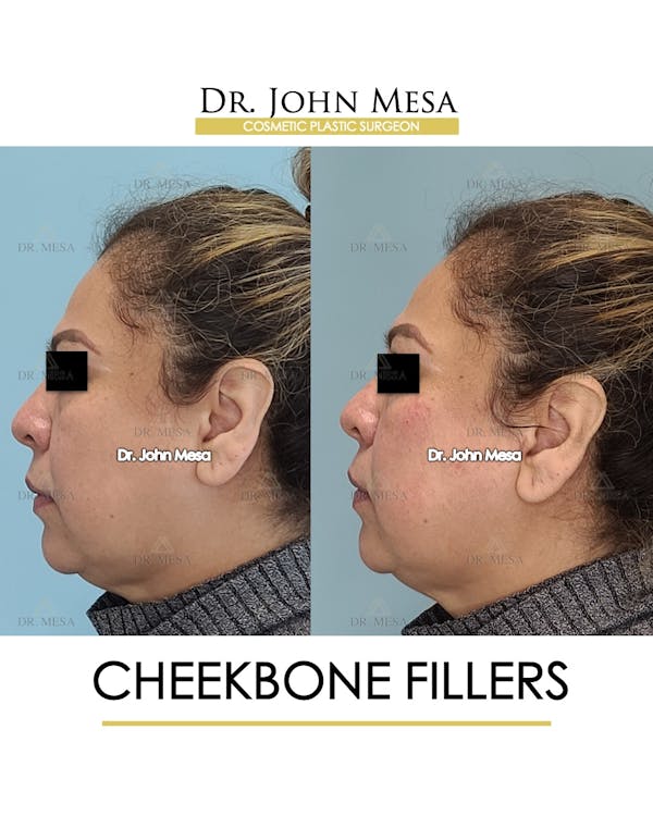 Cheekbone Filler Before & After Gallery - Patient 148735080 - Image 5