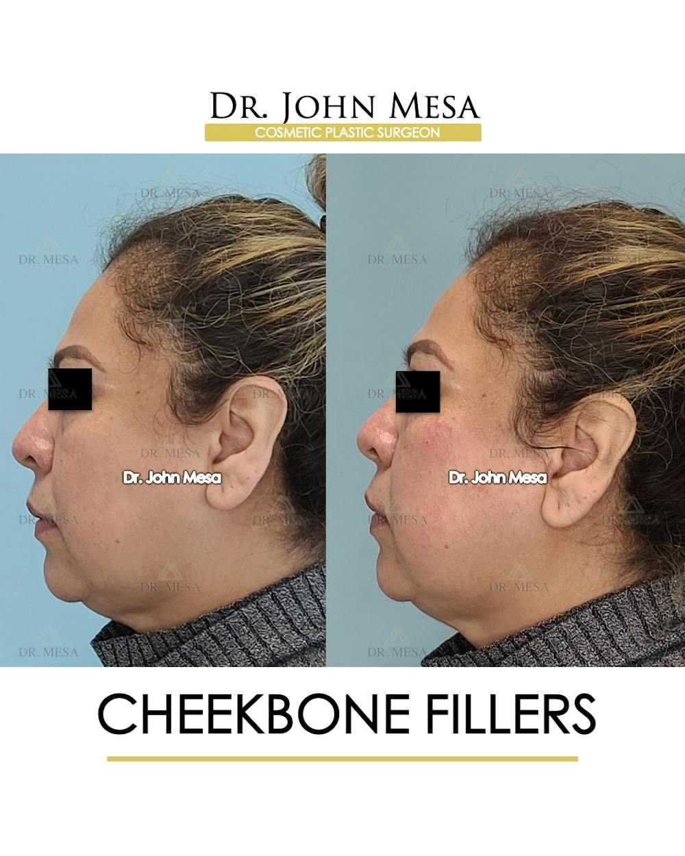 Cheekbone Filler Before & After Gallery - Patient 148735080 - Image 5