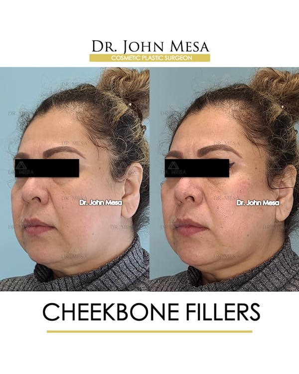Cheekbone Filler Before & After Gallery - Patient 148735080 - Image 4