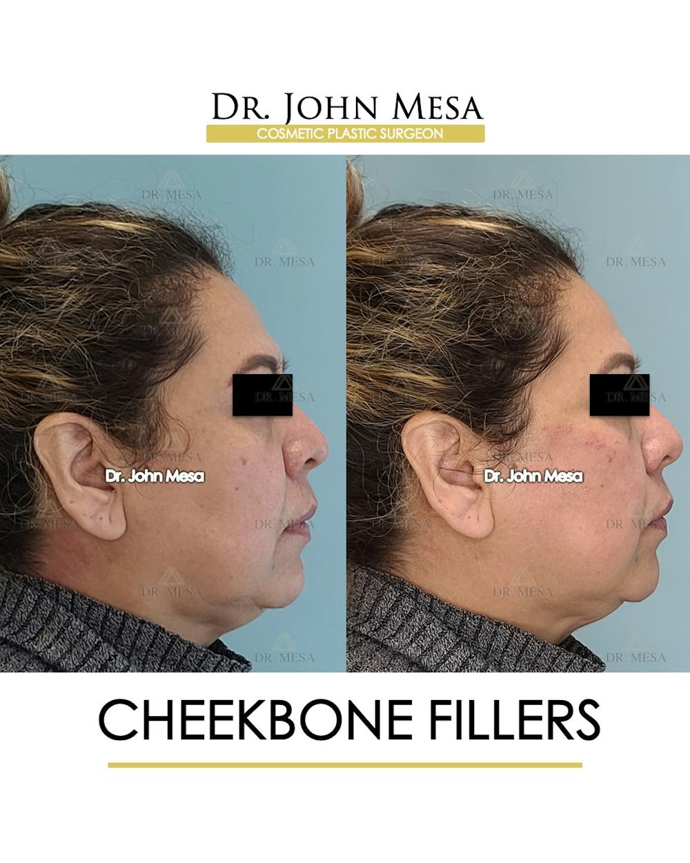 Cheekbone Filler Before & After Gallery - Patient 148735080 - Image 3