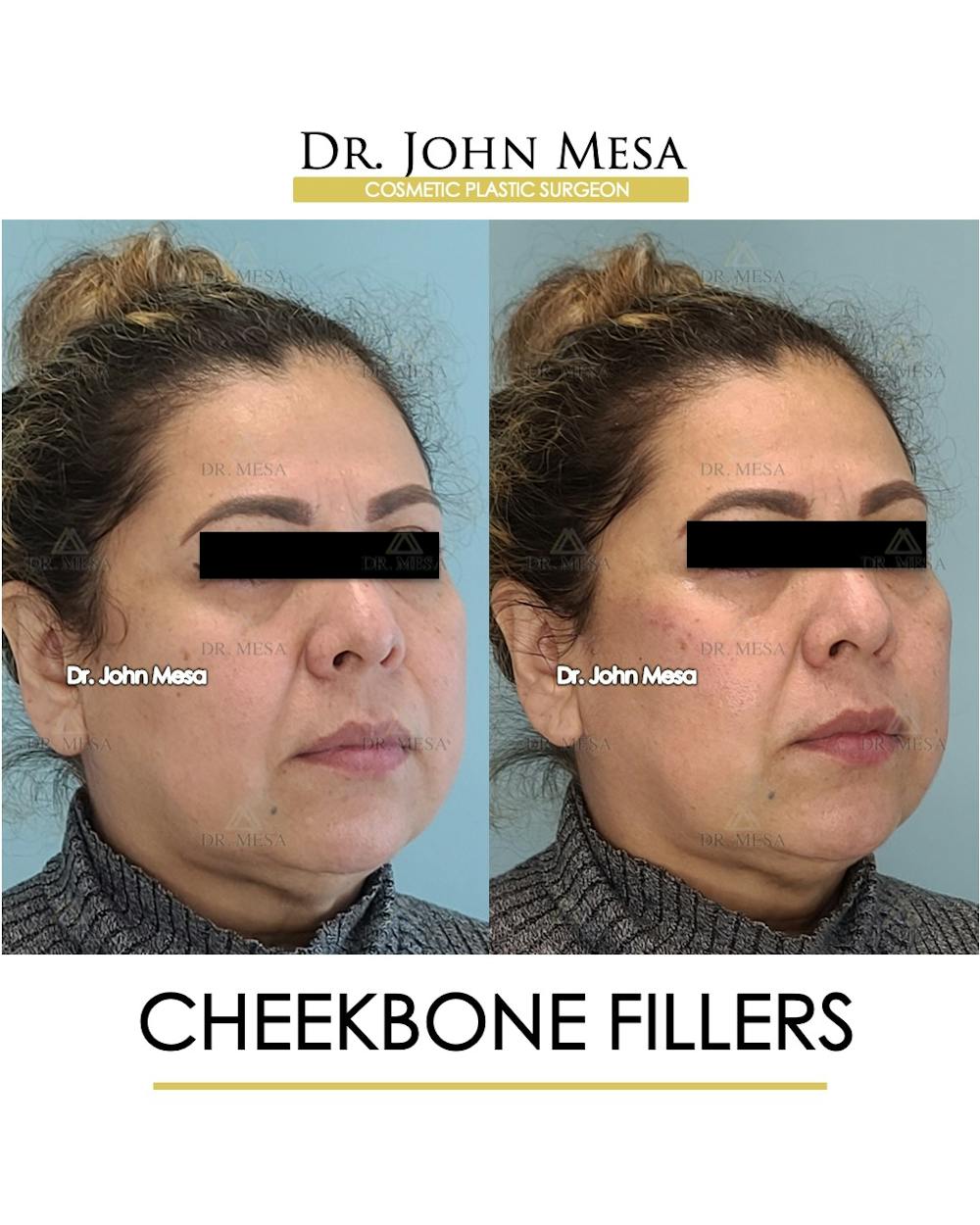 Cheekbone Filler Before & After Gallery - Patient 148735080 - Image 2