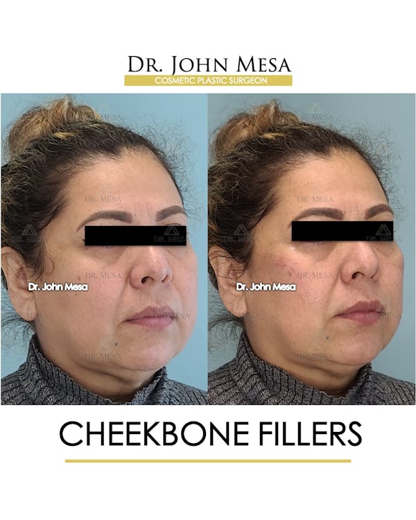 Cheekbone Filler Before & After Gallery - Patient 148735080 - Image 2