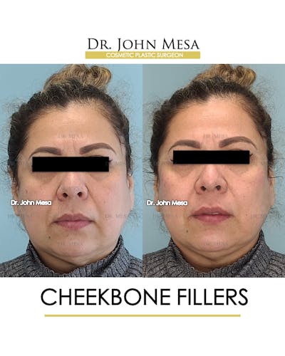 Cheekbone Filler Before & After Gallery - Patient 148735080 - Image 1