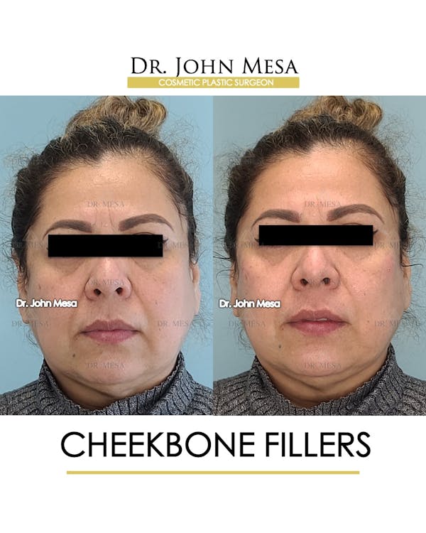 Cheekbone Filler Before & After Gallery - Patient 148735080 - Image 1