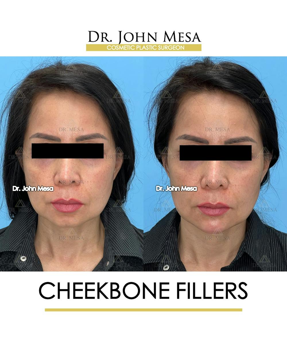 Cheekbone Filler Before & After Gallery - Patient 148735079 - Image 1