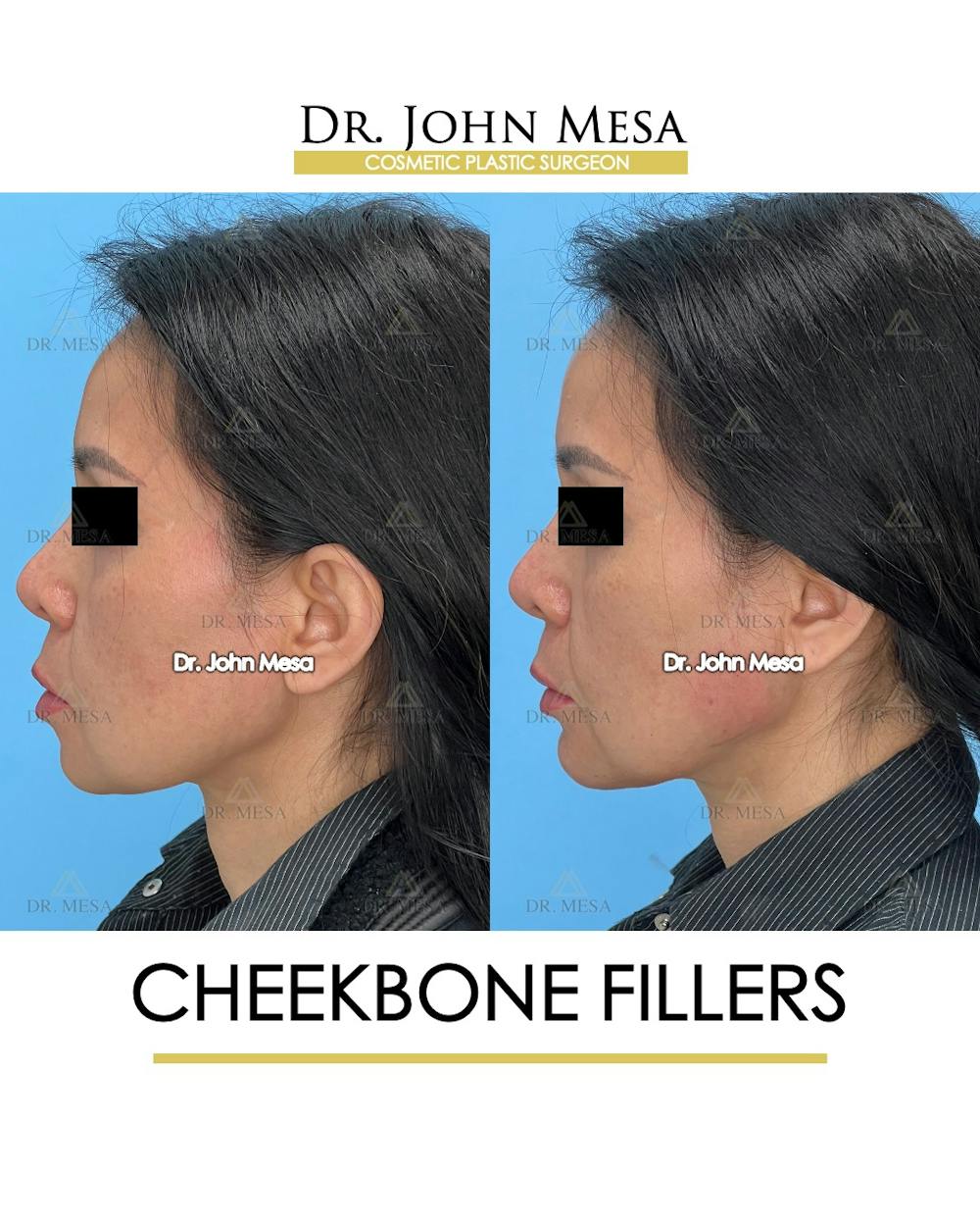 Cheekbone Filler Before & After Gallery - Patient 148735079 - Image 5