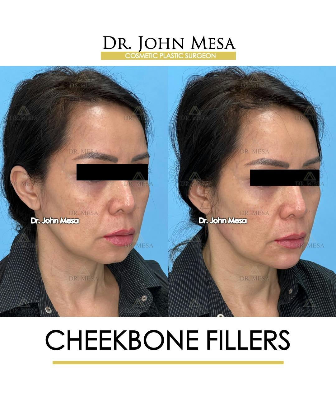 Cheekbone Filler Before & After Gallery - Patient 148735079 - Image 2