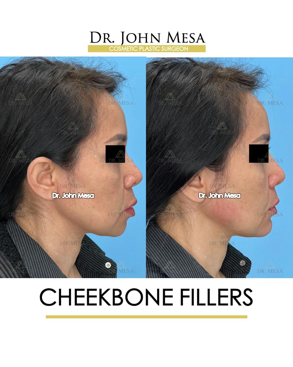 Cheekbone Filler Before & After Gallery - Patient 148735079 - Image 3