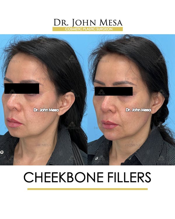 Cheekbone Filler Before & After Gallery - Patient 148735079 - Image 4