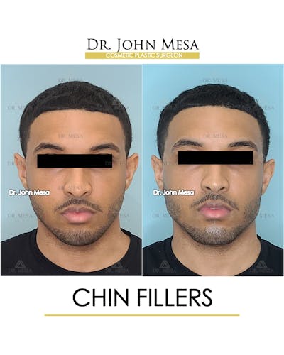 Chin Filler Before & After Gallery - Patient 149284295 - Image 1