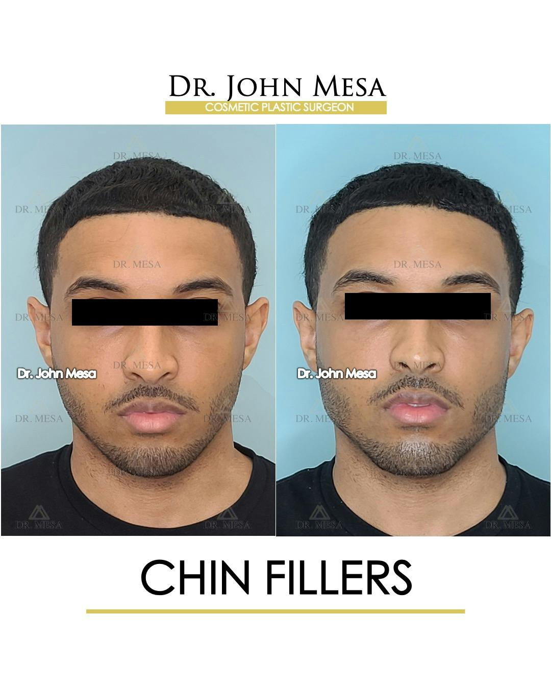 Chin Filler Before & After Gallery - Patient 149284295 - Image 1