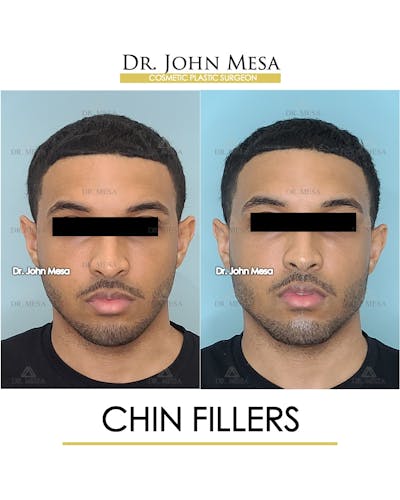 Cheekbone Filler Before & After Gallery - Patient 148735125 - Image 1