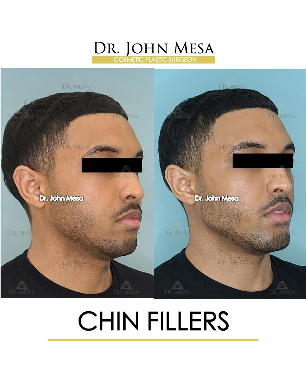 Cheekbone Filler Before & After Gallery - Patient 148735125 - Image 2