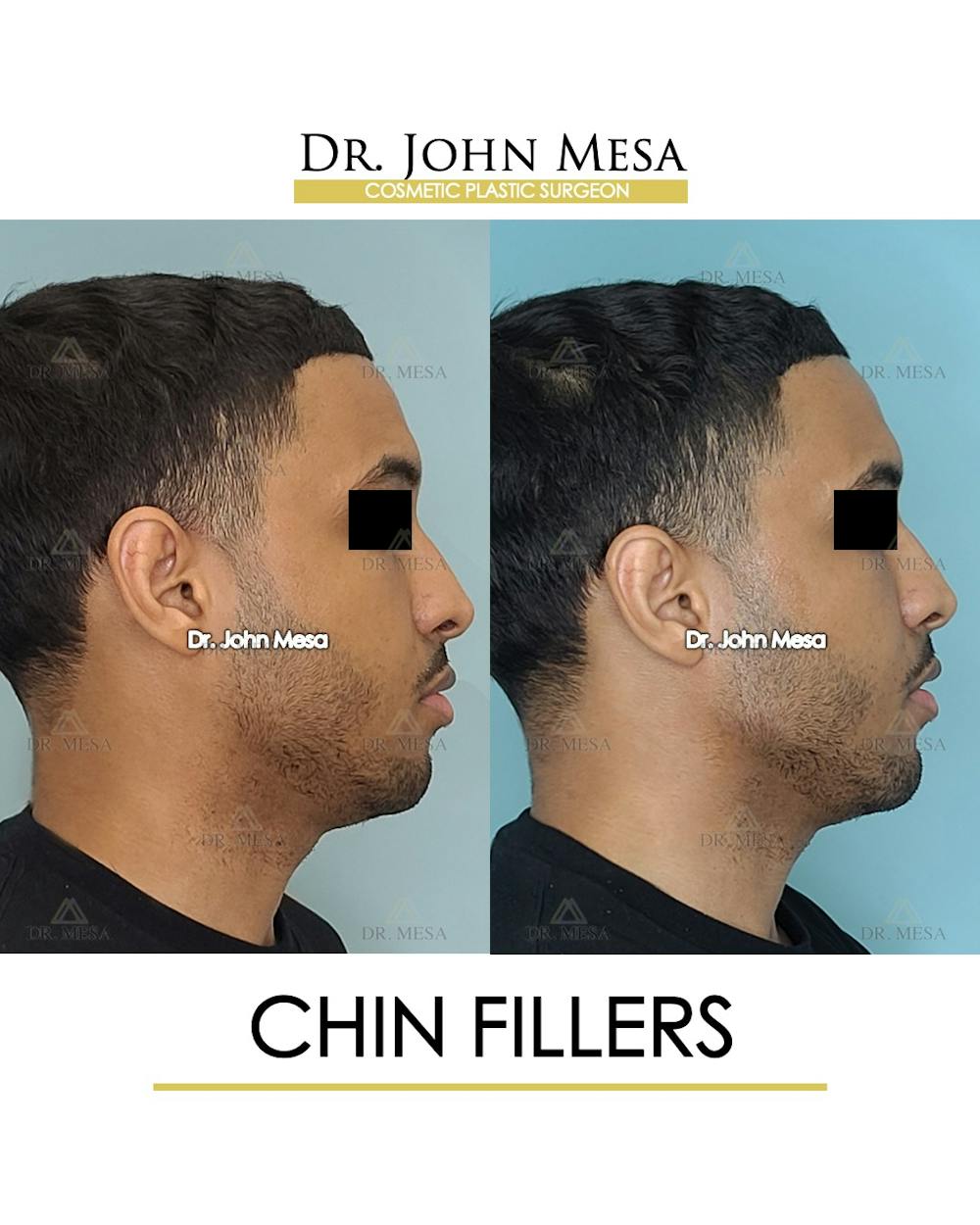 Chin Filler Before & After Gallery - Patient 149284295 - Image 3