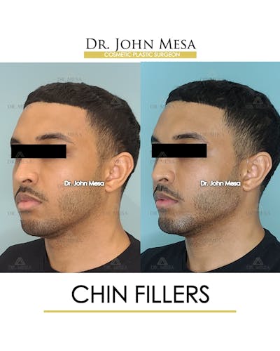 Chin Filler Before & After Gallery - Patient 149284295 - Image 4