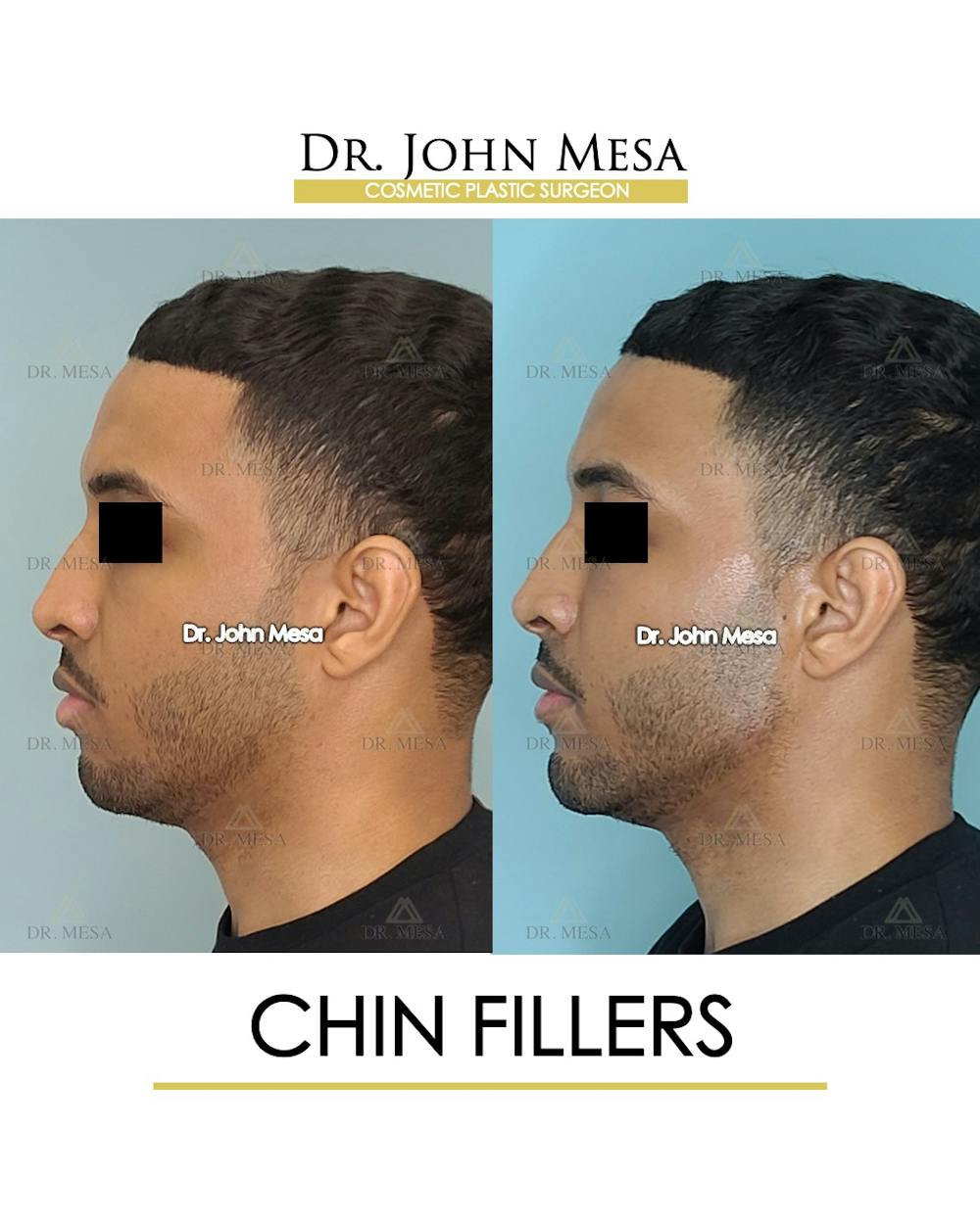 Chin Filler Before & After Gallery - Patient 149284295 - Image 5