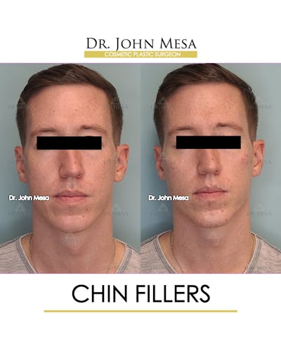 Fillers Before & After Gallery - Patient 148735124 - Image 1