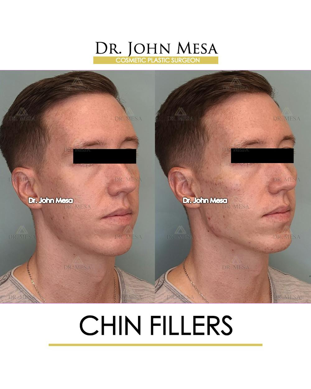 Fillers Before & After Gallery - Patient 148735124 - Image 2