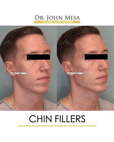 Fillers Before & After Gallery - Patient 148735124 - Image 2