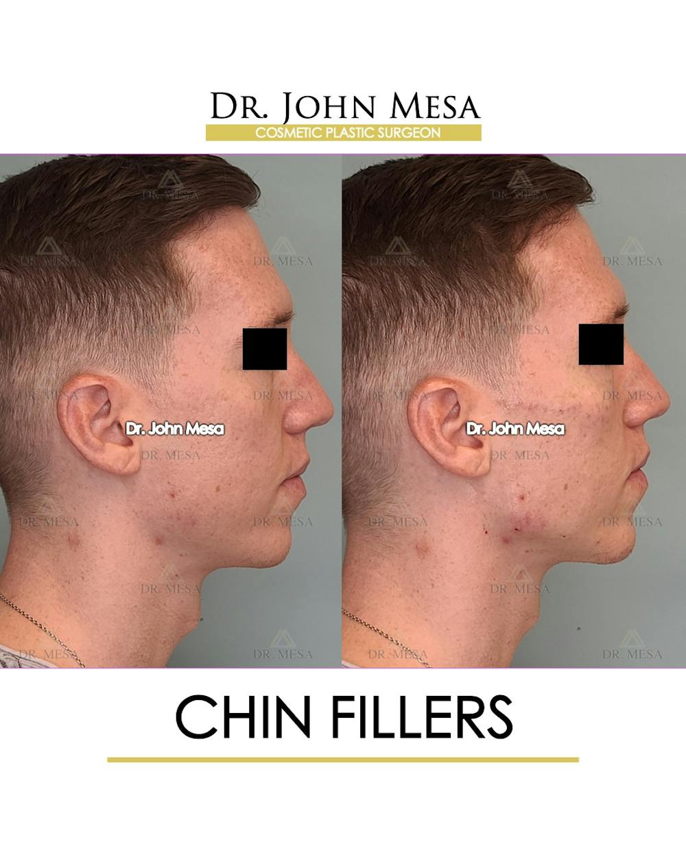 Fillers Before & After Gallery - Patient 148735124 - Image 3
