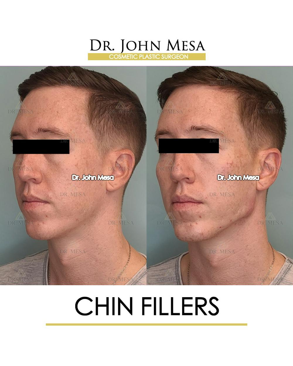 Fillers Before & After Gallery - Patient 148735124 - Image 4