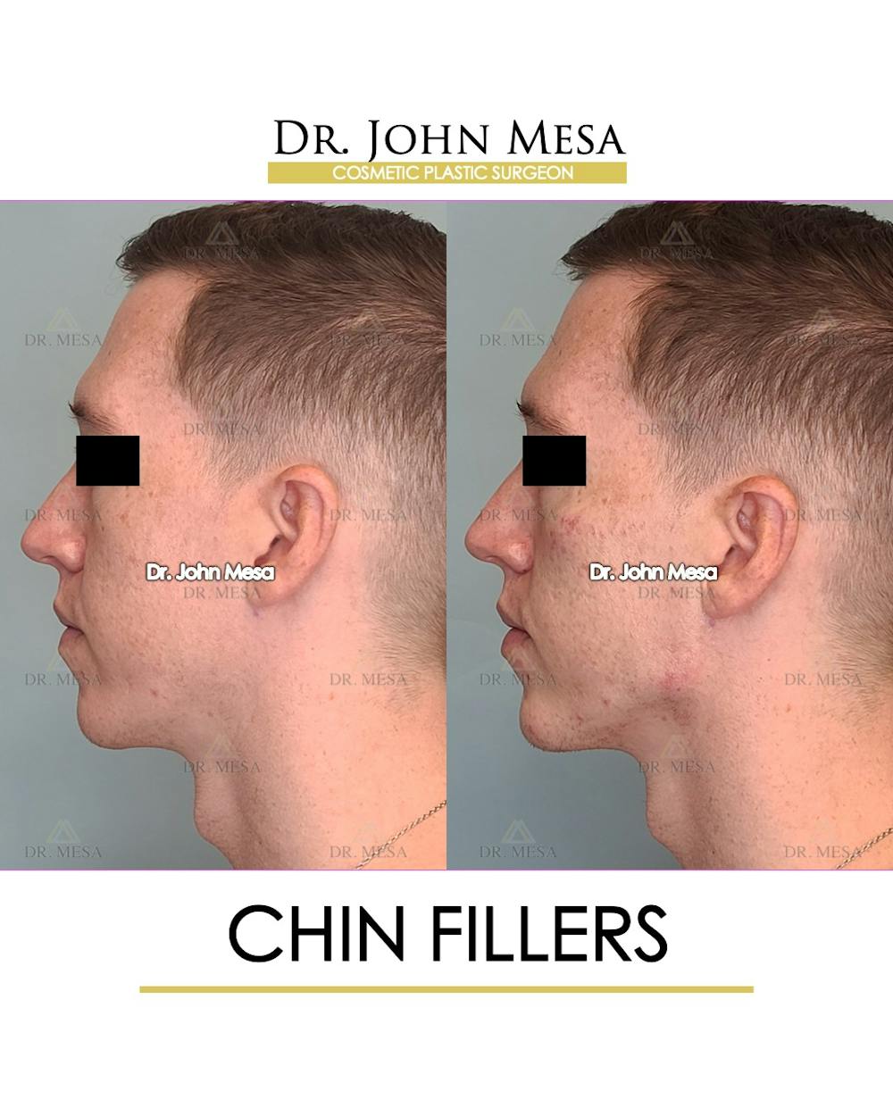 Fillers Before & After Gallery - Patient 148735124 - Image 5