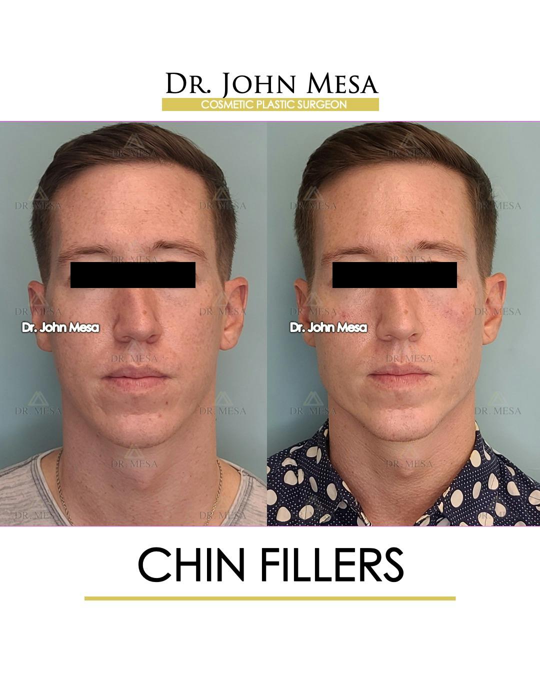 Chin Filler Before & After Gallery - Patient 149284294 - Image 1
