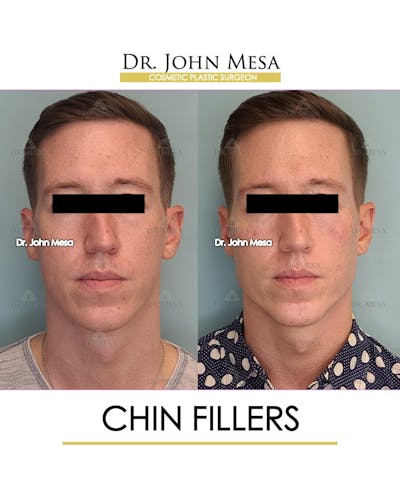 Chin Filler Before & After Gallery - Patient 149284294 - Image 1