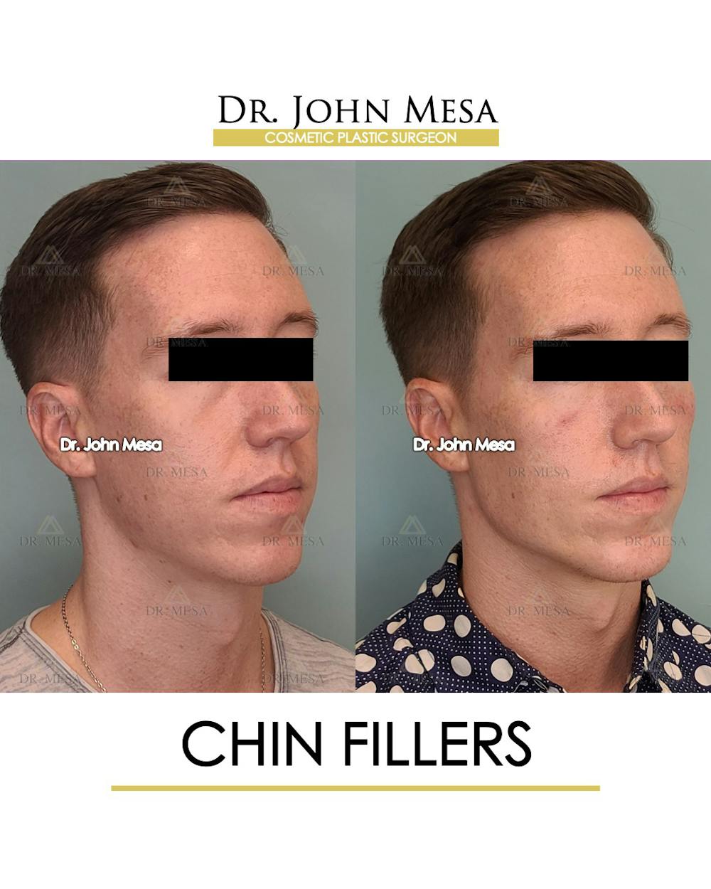 Chin Filler Before & After Gallery - Patient 149284294 - Image 4