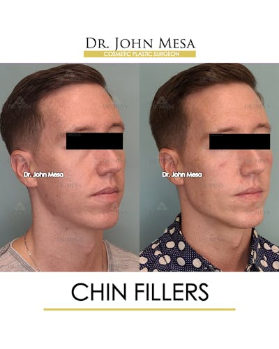 Chin Filler Before & After Gallery - Patient 149284294 - Image 4