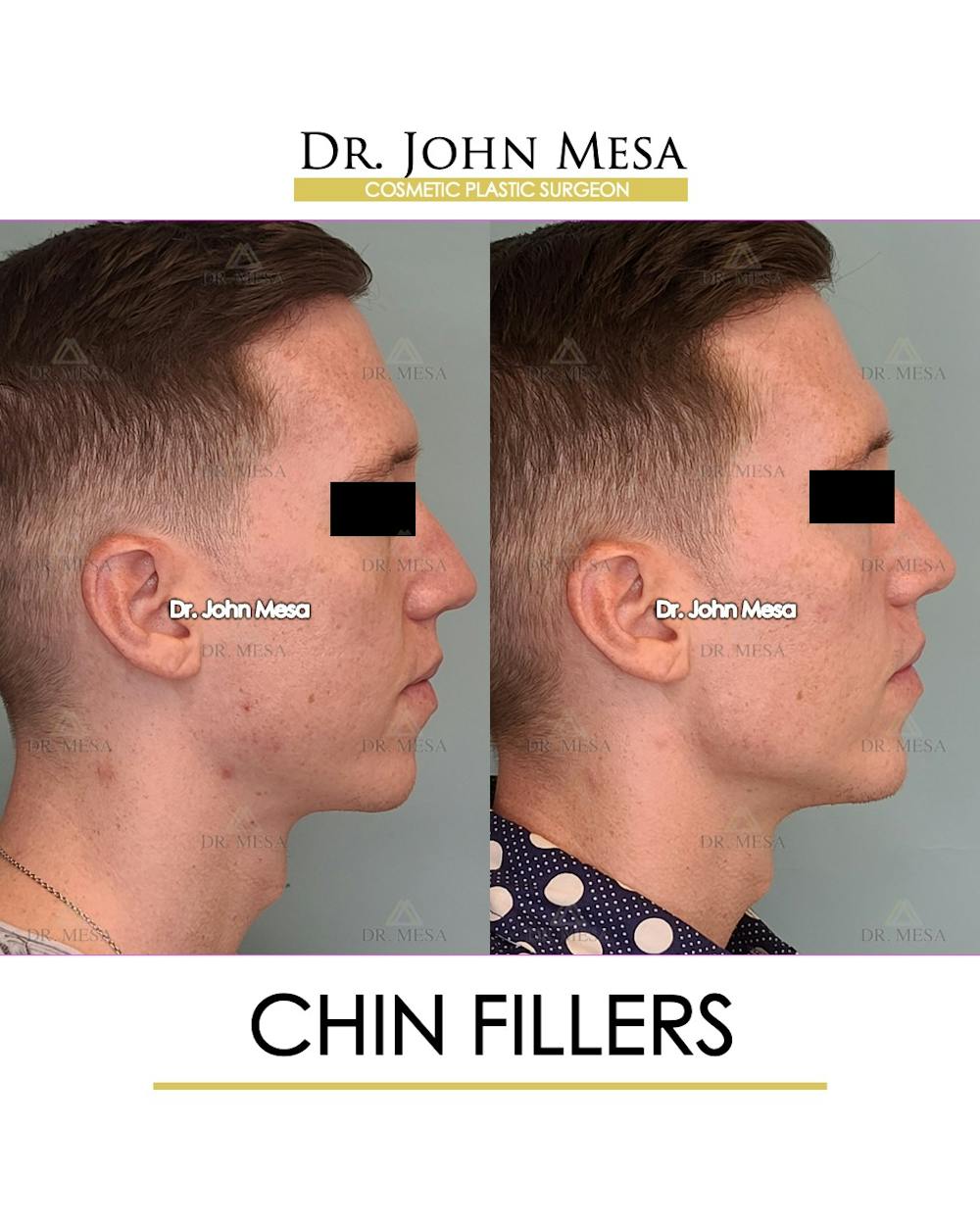 Chin Filler Before & After Gallery - Patient 149284294 - Image 5