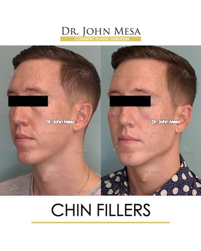 Chin Filler Before & After Gallery - Patient 149284294 - Image 2