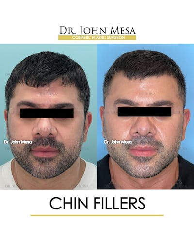 Fillers Before & After Gallery - Patient 148735123 - Image 1