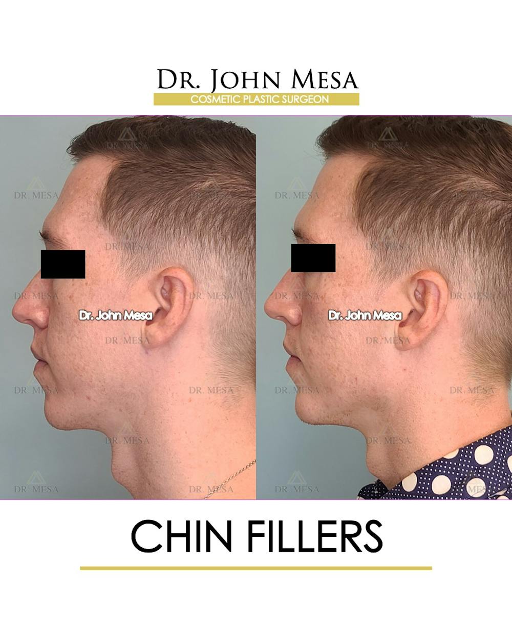 Chin Filler Before & After Gallery - Patient 149284294 - Image 3