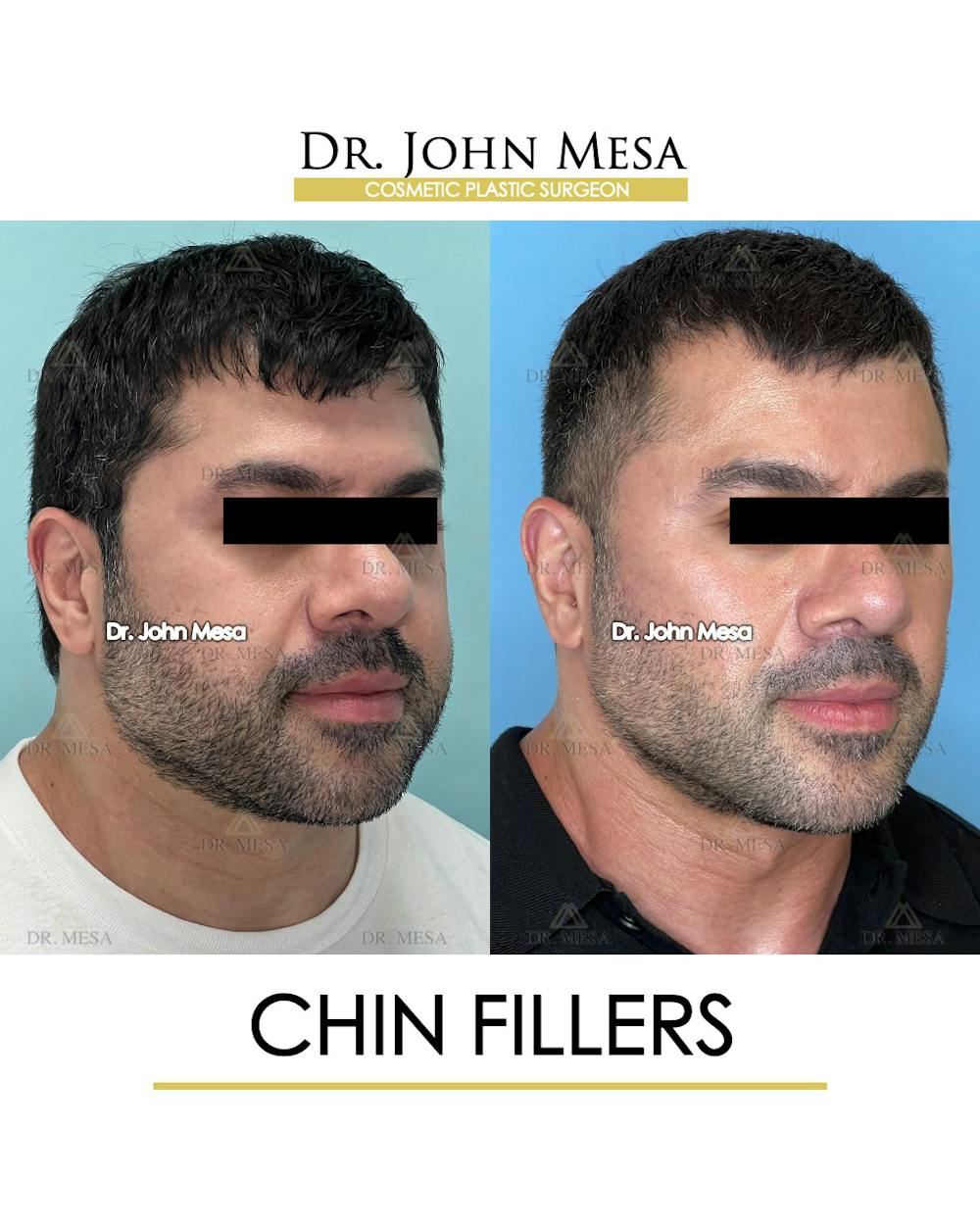 Fillers Before & After Gallery - Patient 148735123 - Image 2