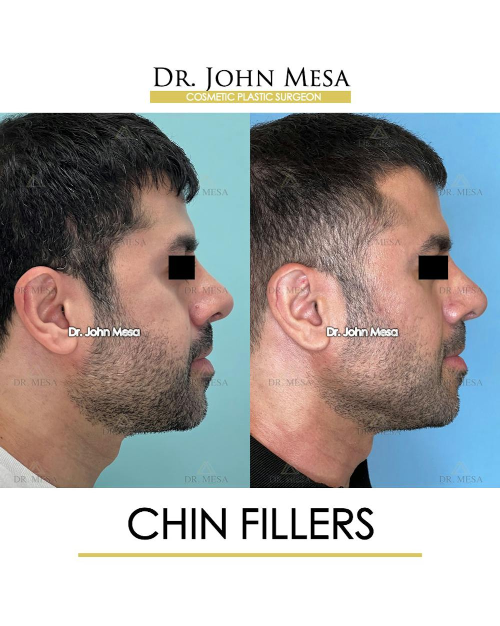 Fillers Before & After Gallery - Patient 148735123 - Image 3