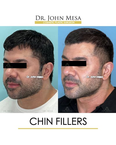 Fillers Before & After Gallery - Patient 148735123 - Image 4