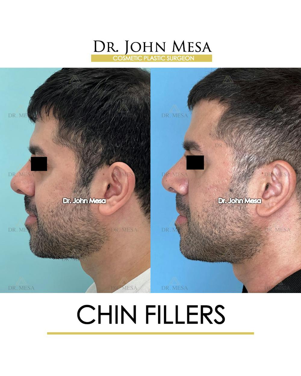 Fillers Before & After Gallery - Patient 148735123 - Image 5