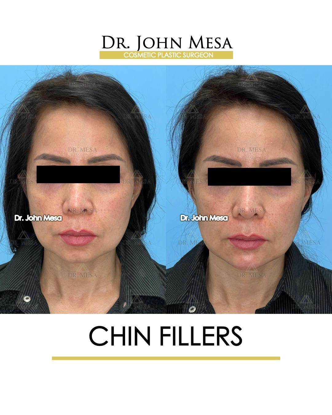 Chin Filler Before & After Gallery - Patient 148735118 - Image 1