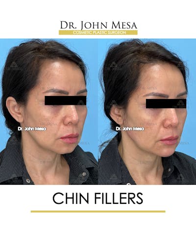 Chin Filler Before & After Gallery - Patient 148735118 - Image 2