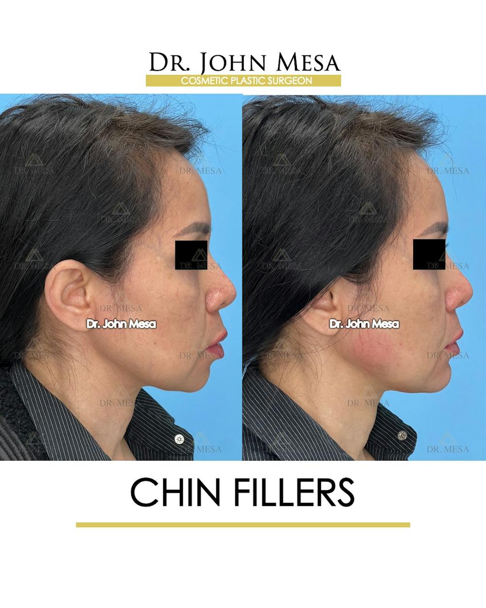 Chin Filler Before & After Gallery - Patient 148735118 - Image 3