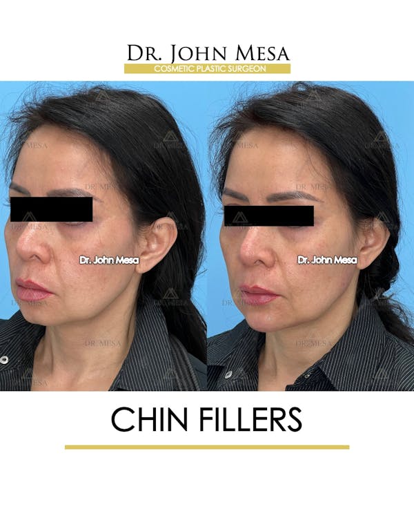 Chin Filler Before & After Gallery - Patient 148735118 - Image 4