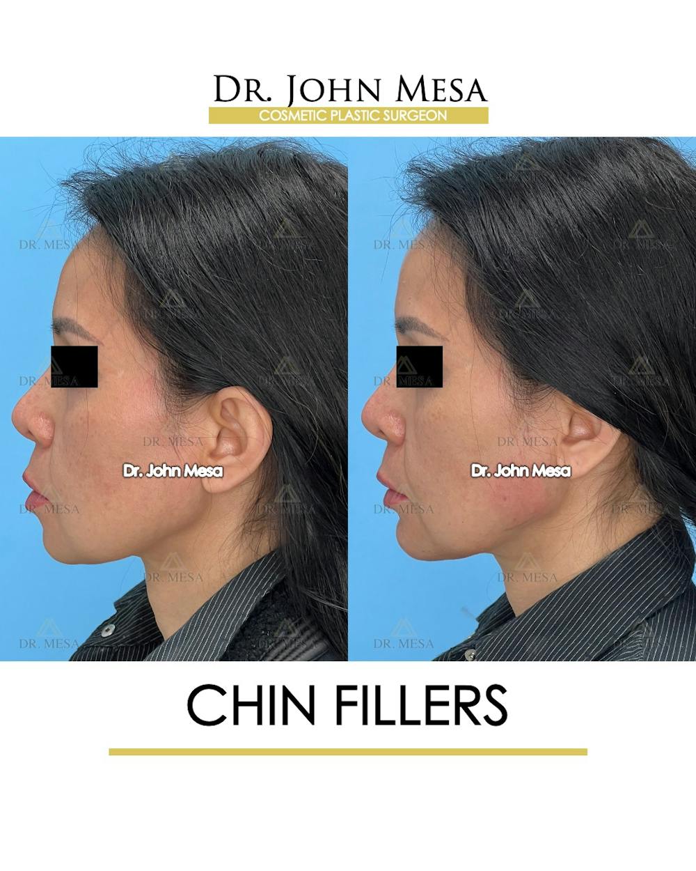 Chin Filler Before & After Gallery - Patient 148735118 - Image 5