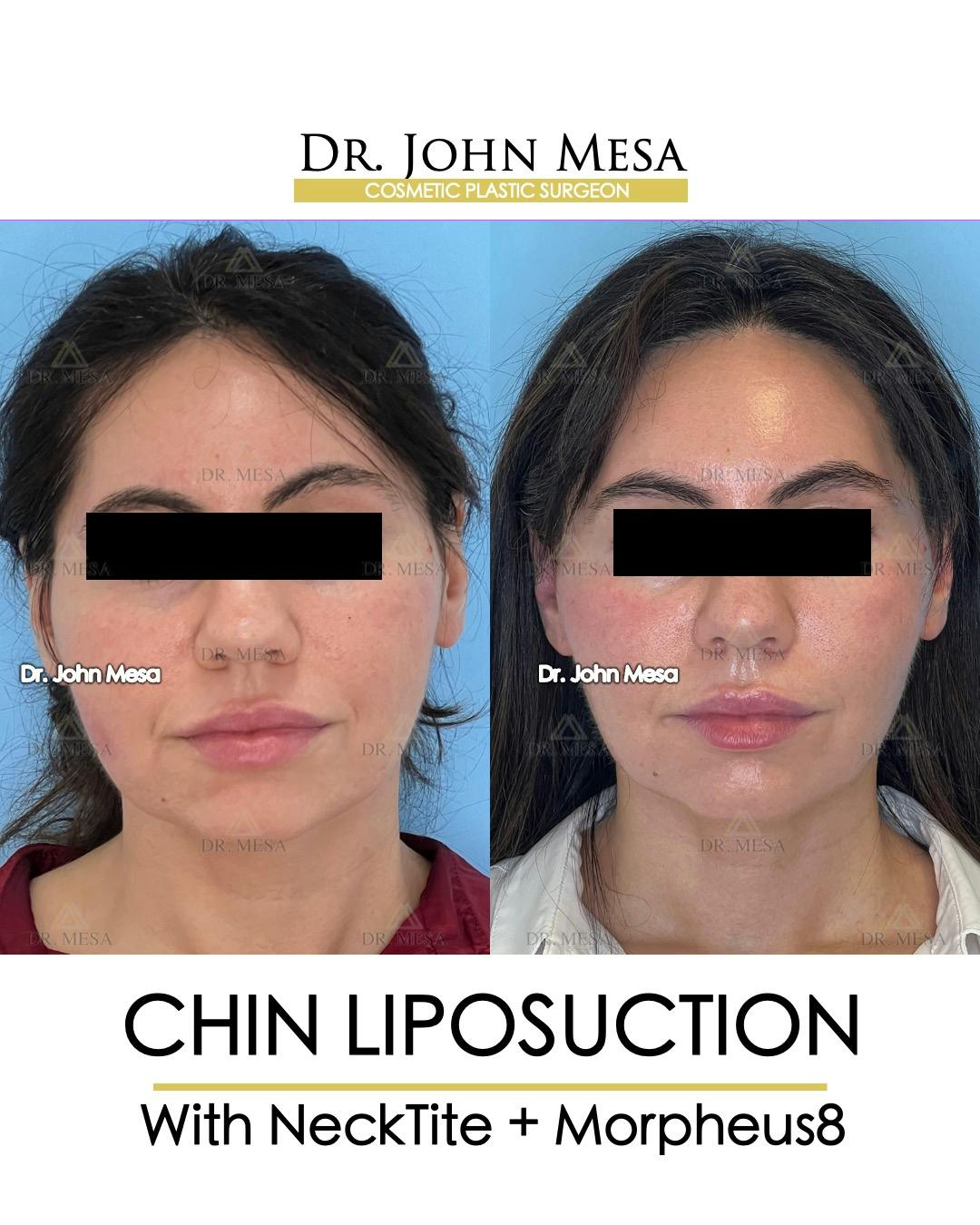 Chin Liposuction Before & After Gallery - Patient 148735136 - Image 1