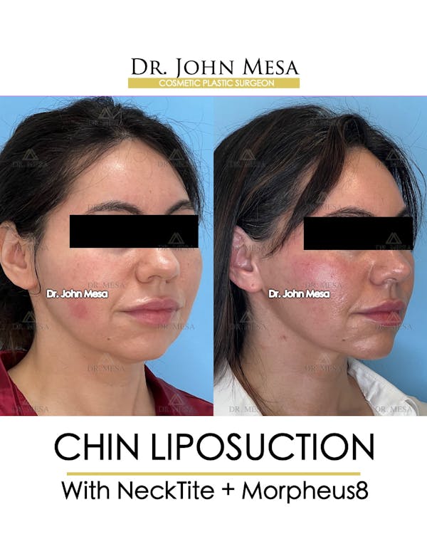 Chin Liposuction Before & After Gallery - Patient 148735136 - Image 2