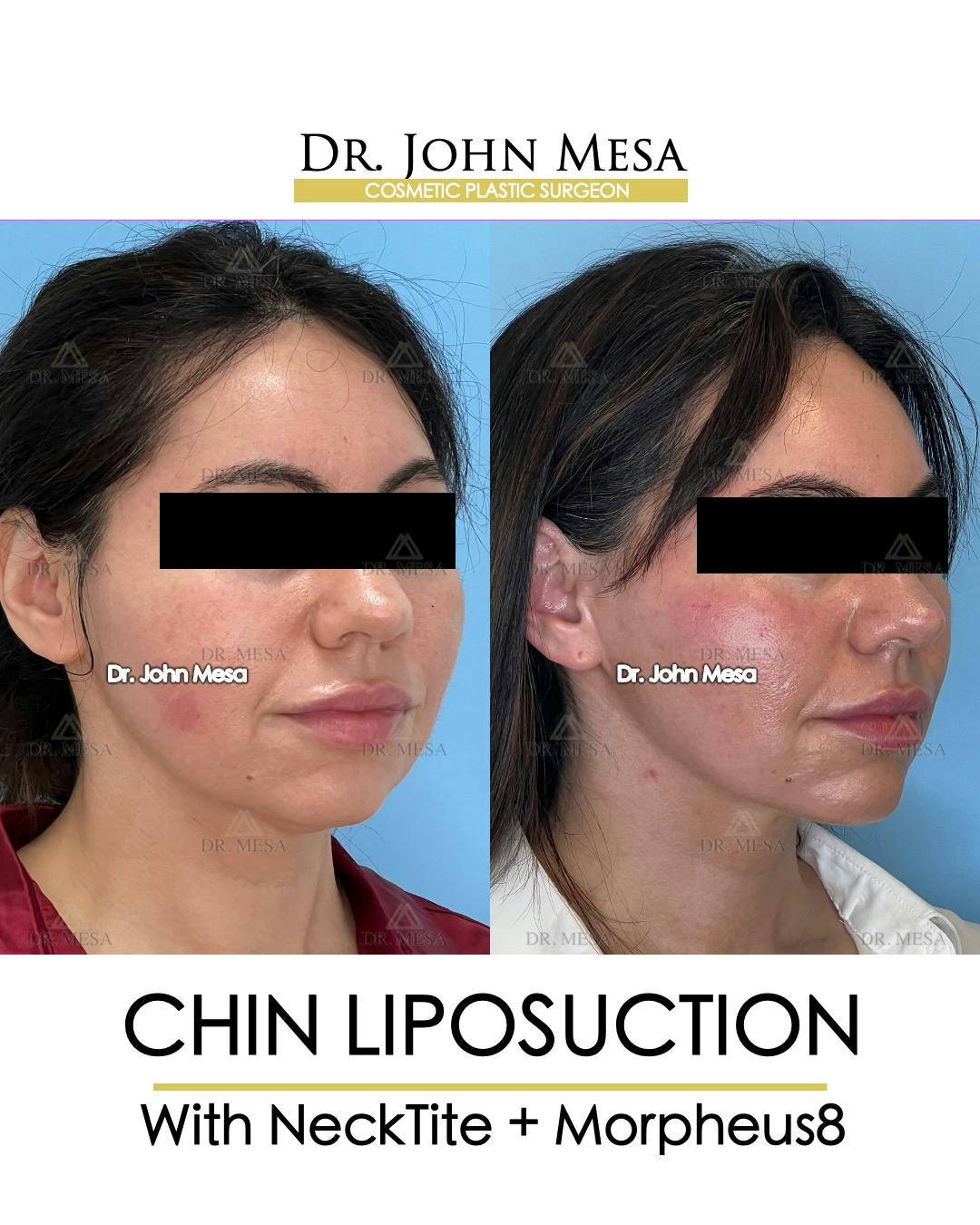 Chin Liposuction Before & After Gallery - Patient 148735136 - Image 2